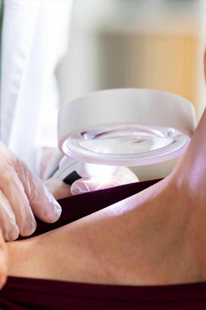 prevencion-carcinoma